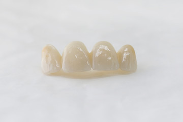 Zahnmedizin, Zirkon, Vollkeramik