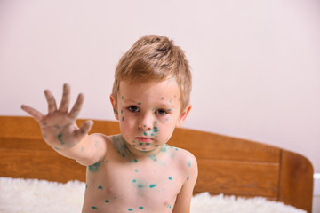 Young toddler,boy with chickenpox. Sick child with chickenpox. Varicella virus or Chickenpox bubble...