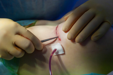 Hospital. Surgeon operates in the operating room. Close up of the surgeon's hands examining the...
