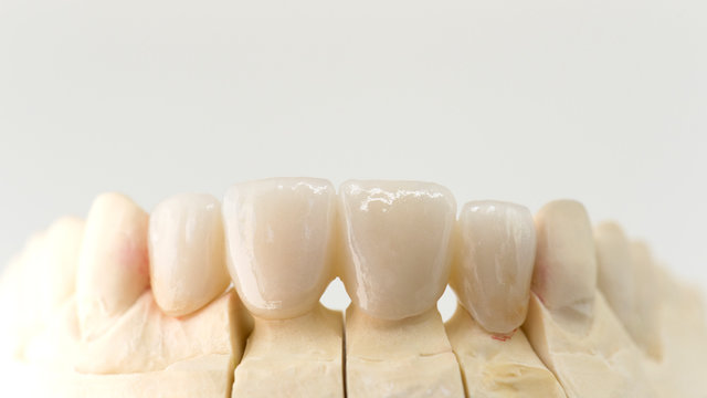 Zahnersatz, Vollkeramik, Dentallabor