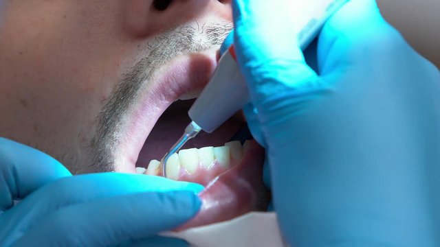 Plaque and tartar cleaning. Close-up of a man's open mouth during dental brushing. hands in rubber gloves holding a dental tool do ultrasonic teeth cleaning of a client in a dental clinic.