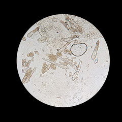 Demodex mite from a microscope view. The parasite causing a skin disease -Demodecosis.