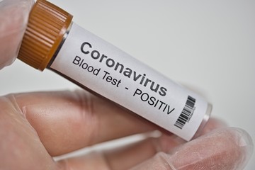 2019-nCoV Coronavirus. Positive blood sample held in one hand with laboratory glove. Respiratory syndrome. Corona virus outbreak