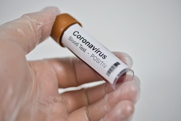 2019-nCoV Coronavirus. Positive blood sample held in one hand with laboratory glove. Respiratory...