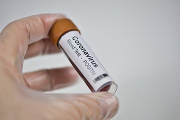 2019-nCoV Coronavirus. Positive blood sample held in one hand with laboratory glove. Respiratory...
