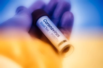 2019-nCoV Coronavirus. a positive blood sample in the  held in one hand with laboratory glove. Respiratory syndrome. Corona virus outbreak