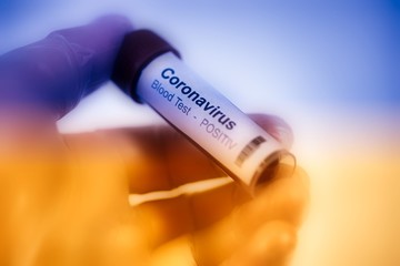 2019-nCoV Coronavirus. a positive blood sample in the  held in one hand with laboratory glove....