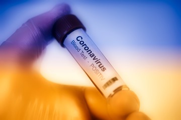 2019-nCoV Coronavirus. a positive blood sample in the  held in one hand with laboratory glove....