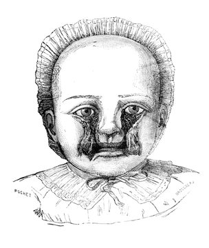 Double rabbit case with division of the cheeks to the eyelids in the old book D'Anatomie Chirurgicale, by B. Anger, 1869, Paris