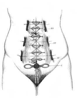Ovariotomy (arrangement of sutures) in the old book D'Anatomie Chirurgicale, by B. Anger, 1869, Paris