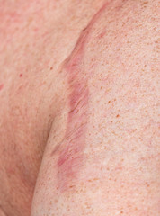 Fototapeta premium A scar on a man’s skin