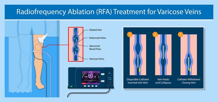 endovenous laser treatment CVD treat ELT legs inject EVLT varicose veins Radiofrequency Ablation RFA	