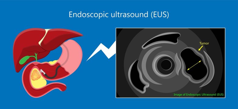 Medical Endoscopic Ultrasound EUS Cancer Tumor Diagnose FNA Abdominal Test CT Scan MRI Colon Stomach Gastric Rectal Organs Examine Rectum Acute Abnormal Esophageal Needle Pain Ulcer Pancreas Nodule