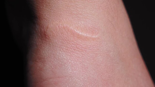 traces of a cut on the hand, a scar on the hand close-up macro. selective focus, human hand