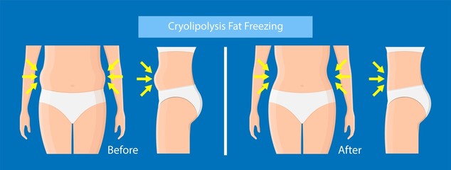 cryolipolysis fat freezing procedure cold treatment non invasive medication reduce temperature break down fat cells removal cosmetic surgery adipose  liposuction Coolsculpting