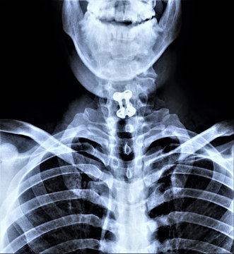 x- ray of the cervical spine with osteosynthesis of the seventh cervical vertebra