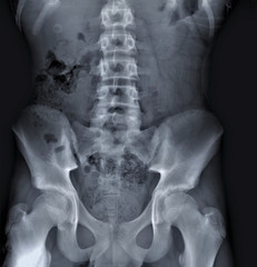 x- ray of the abdomen, spine and pelvis