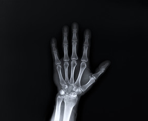 x-ray of the hand and wrist bones