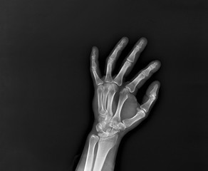 x-ray of the hand and wrist bones