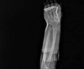 x- ray of the wrist joint with a fractured radius