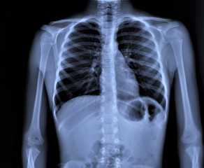 chest x-ray, diagnosis of coronavirus pneumonia