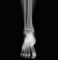 x- ray of the ankle joint in the frontal projection, arthritis, arthrosis