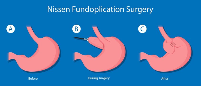 Gastroesophageal reflux disease (GERD) Hiatal Hernia treatment medication