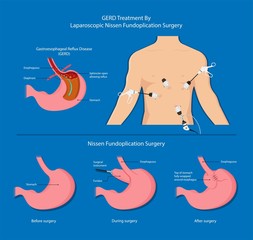 Gastroesophageal reflux disease (GERD) Hiatal Hernia treatment medication