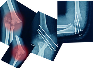  X-ray elbow showing  Supracondylar humerus fracture and post opretion fix K-wire.