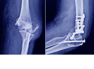 Film Elbow fracture medial epicondyle humerus bone and post operated with internal fixed by plate...