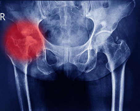 Both hips joint x-ray showing destruction head right femur and erosion acetabulum with widening right hip joint from chronic arthritis.Medical image concept.