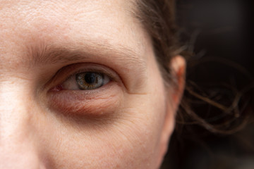 Swelling of the eyelid of a Caucasian woman's eye which causes bags under the eyes