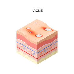 Acne vulgaris or pimple cross-section of human skin layers structure skincare medical concept flat vector illustration