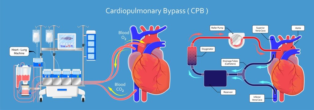 Cardiopulmonary bypass heart lung machine coronary oxygenator perfusiologist cardiologist operating life support artery graft circulation repair mitral tricuspid pulmonic septal defect aneurysms aid