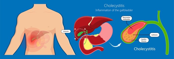 HIDA scan diagnosis treat liver scintigraphy inject cells scanner congenital abnormal leaks test abdomen acute imaging blocked radiology hepatobiliary iminodiacetic acid transplant gallstones 