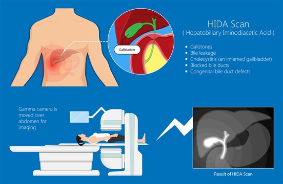 HIDA scan diagnosis treat liver scintigraphy inject cells scanner congenital abnormal leaks test abdomen acute imaging blocked radiology hepatobiliary iminodiacetic acid transplant gallstones 
