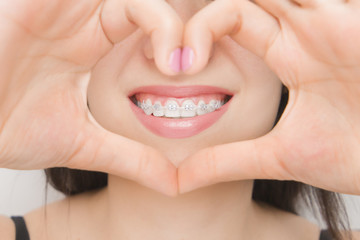 Dental braces in happy womans mouths through the heart. Brackets on the teeth after whitening. Self-ligating brackets with metal ties and gray elastics or rubber bands for perfect smile.