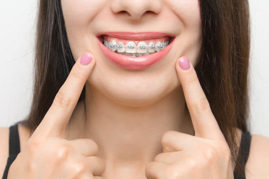 Dental braces in happy womans mouths who shows by two fingers on brackets on the teeth after whitening. Self-ligating brackets with metal ties and gray elastics or rubber bands for perfect smile.