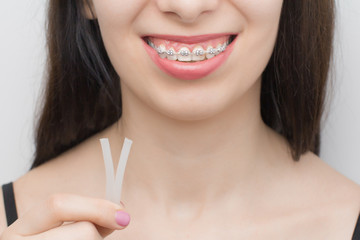 Applying orthodoentic wax on the dental braces. Brackets on the teeth after whitening....