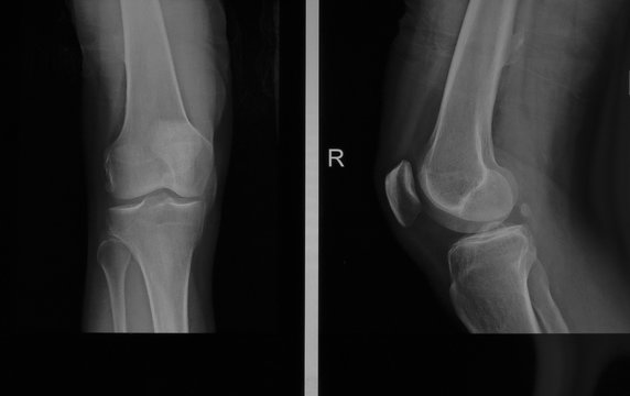 X-ray edk in the knee joint in two projections of an adult male with osteoarthritis. Selective focus. Blur. Noise, sharpness and grain are typical for X-rays. Horizontal orientation.