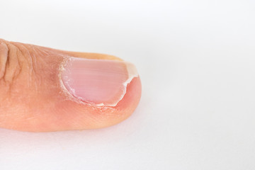 男の手、割れた中指の爪 