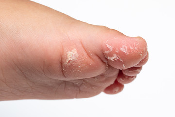 exfoliating mask for the feet: concept of skin peeling