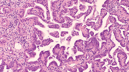 Adenocarcinoma in situ of lung (lepidic growth pattern, formerly 