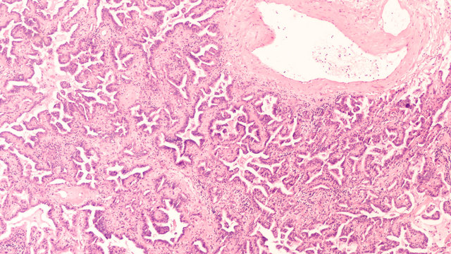 Adenocarcinoma in situ of lung (lepidic growth pattern, formerly "bronchoalveolar carcinoma"); the cancer cells grow along the scaffolding of preexisting pulmonary alveoli, without stromal invasion.  