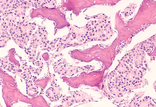 Metastatic prostate cancer: Photomicrograph of bone biopsy showing metastasis of prostatic adenocarcinoma within the marrow space.  