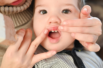 A wound on the childs lip. He rubbed his lip with his mothers nipple. A wound on the babys lip after sucking on the mothers breast.