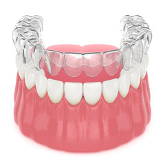 3d render of invisalign removable retainer with lower jaw