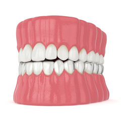 3d render of jaw with invisalign removable retainer