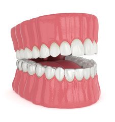 3d render of jaw with invisalign removable retainer