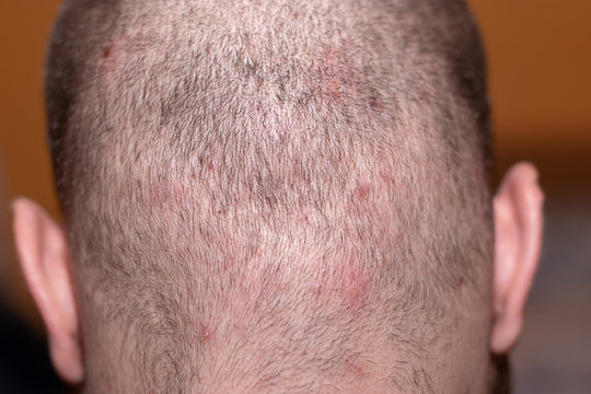 Back Side Of A Man's Head Suffering From Scalp Acne